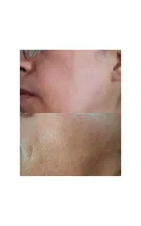 حلزون درمانی معجزه درمان لک و روشنایی پوست