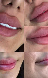 تزریق فیلر و بوتاکس بصورت تخصصی در فولادشهر