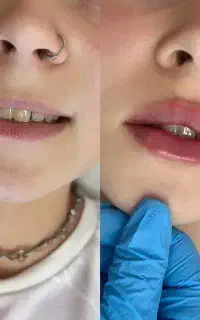 تخفیف عیدانه فیلر بوتاکس چال لپ ژل پیرسینگ فیشیال