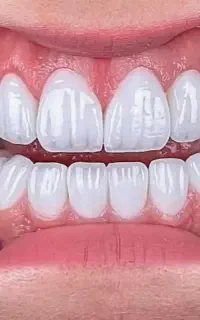 دندانپزشکی ایمپلنت، لمینت، کامپوزیت و درمانی