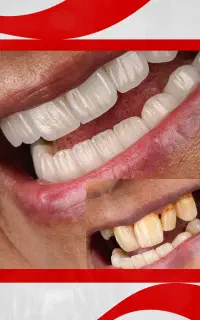 کامپوزیت لیرینگ طرح لمینت/ نقاشی لبخند