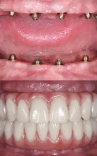 دندانپزشکی تخصصی، ایمپلنت،اوردنچر اقساطی+وام پزشکی
