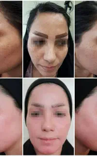 کاشت مو طبیعی،بدون ورم و کبودی.لیزر ترکیبی co2