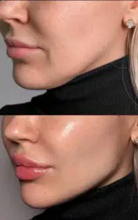 بوتاکس و فیلر پی ار پی لیفت نخ مزوتراپی کانتورینگ
