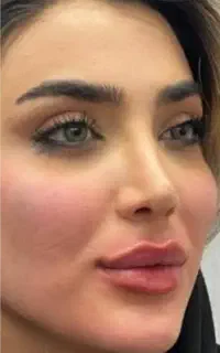 جشنواره تزریق بوتاکس ۹۰۰وفیلرکره ایی ۱۱۰۰تضمینی