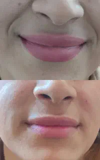 تزریق ژل و بوتاکس