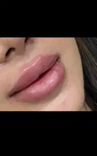 تزریق ژل
