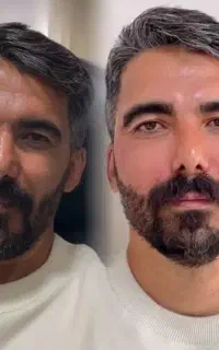 کلینیک فیلربیکینی باسن هیپ دیپ صورت