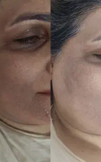 فیشیال و آبرسانی و درمان هر نوع مشکل پوست