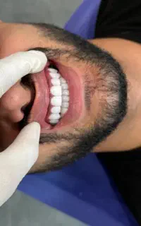 شرایط اقساطی برای کامپوزیت فکی۱۴وعصبکشی وپرکردن۳م