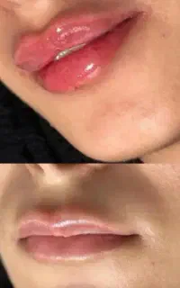 ژل،بوتاکس، لیزرخال و تاتو،ریمور