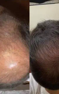 تا وقتی تاس نشدی درمان کن