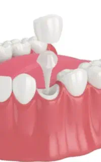 عصب‌کشی دندان، روکش و ترمیم با تعرفه دولتی