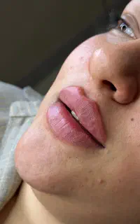 انجام تزریق ژل بوتاکس مزو ها و پیرسینگ