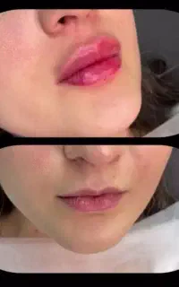 جشنواره تابستانه ژل و بوتاکس