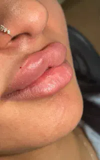 خدمات ژل و بوتاکس