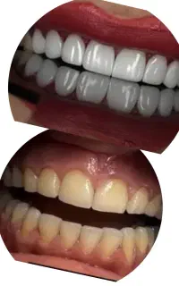 کامپوزیت و پر کردن دندان
