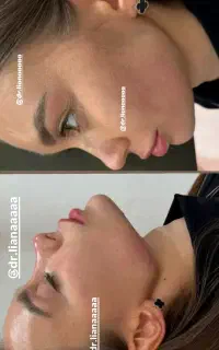 خدمات زیبایی فیلر و بوتاکس با تخفیفات بهاره