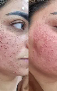 صافی مو کراتین وپروتین وخال برداری