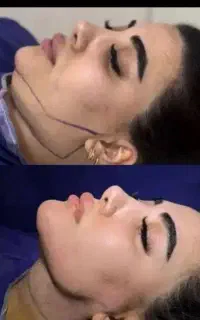 لیپوبازاویه سازی فک