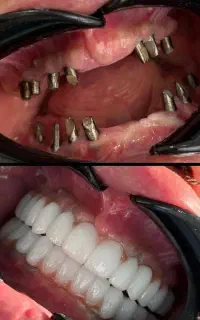 شرایط ویژه ایمپلنت،ویزیت رایگان