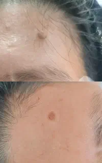 برداشتن انواع خال و لک بادستگاه پزشکی در1جلسه