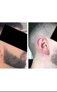ریش تراپی