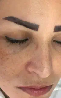 برداشت انواع لک.کک ومک.خال.زگیل