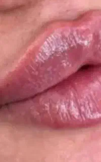 فیلر و بوتاکس وجوانساز