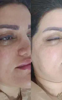 پاکسازی صورت (با تخفیف ویژه فقط ۳۰۰ تومن)