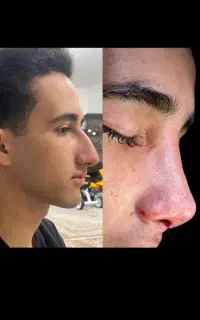 جراحی زیبایی بینی