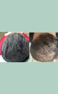 میکرو اسکالپ سر آقایان و خانم ها