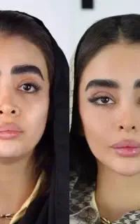 بوتاکس فیلر لب  کانتورینگ خالبرداری زیبایی بیکینی