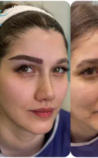کاشت ابرو ، میکرو کاشت کرج
