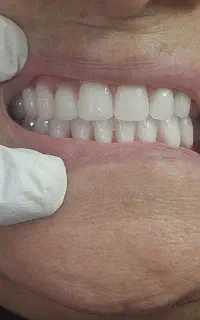 دندان سازی ،