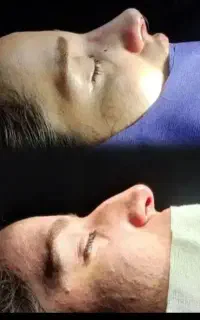 انواع عمل زیبایی در بیمارستان بینی.غبغب.بلفارو.ژل