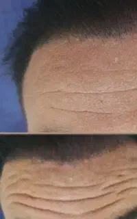 جشنواره ویژه بوتاکس