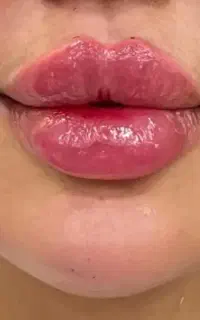 تزریق ژل و بوتاکی فقط ۹۰۰