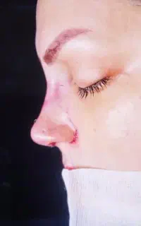 آف جراحی بینی فقط ۳۵ تا ۴۰ اهواز