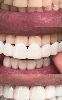 لمینت متحرک دندان  دو فک برند ترو اسمایل