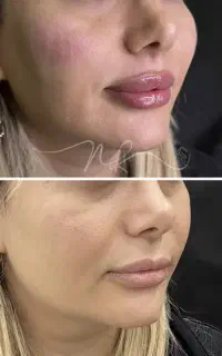 کلینیک تخصصی فرسیما/لیفت نخ/کانتورینگ/فیلر/بوتاکس