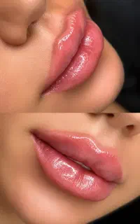 آفر طلایی تزریق ژل، بوتاکس و آنزیم