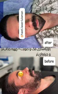 لیزر ۲۰۲۵ بدون درد فول 650 تضمینی+روشن شدن پوست