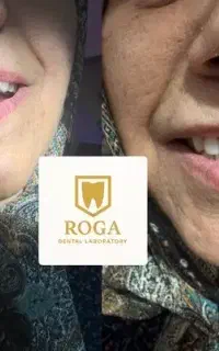 دندان مصنوعی/اوردنچر/ژله ای/نایت گارد/دندانسازی