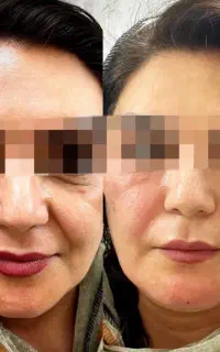 بدون ژل، دائمی و ارزان صورتت رو پر و جوان کن