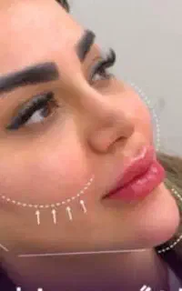 کلینیک تزریق ژل لبMبوتاکس۳۴۹رفع سیاهی چشم لیزر خال