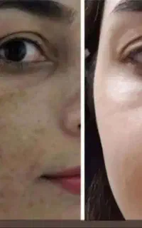 کرم ضدلک و روشن کننده درخشان