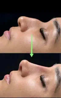 کوچک کردن بینی و فرم دهی در کمترین زمان ممکن