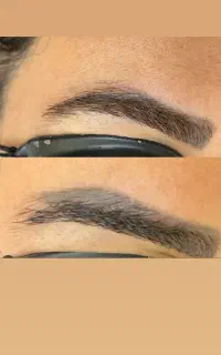 حذف تتو و روشن و شفاف شدن پوست با لیزر کیوسوئیچ