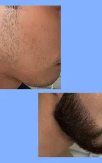 سرم رویش ریش سیبیل و موسر
